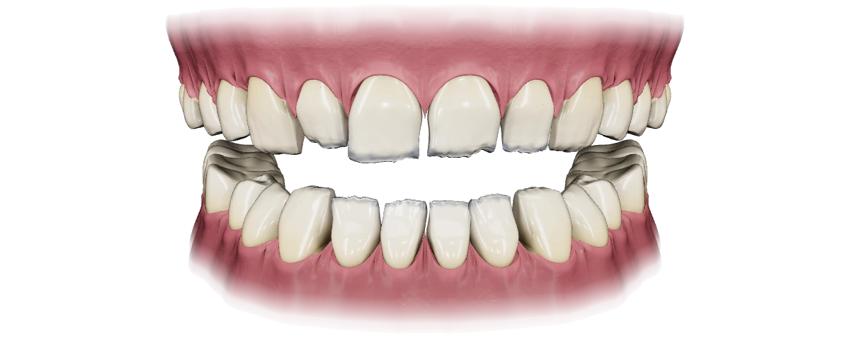 Denti sbiancati